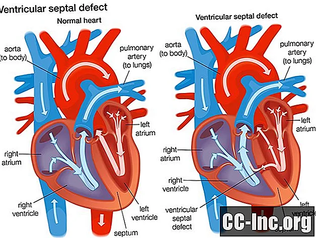 Defect in het ventriculaire septum