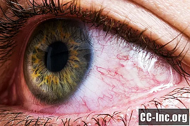 Varningstecken på att ditt röda öga kan vara allvarligt