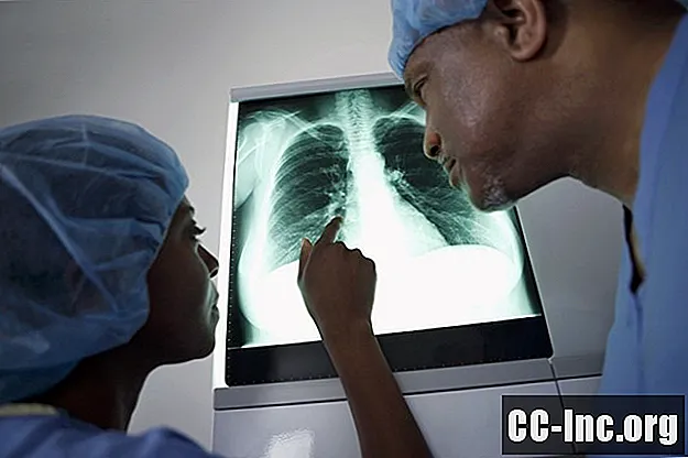 Kas yra karcinoidiniai plaučių augliai?