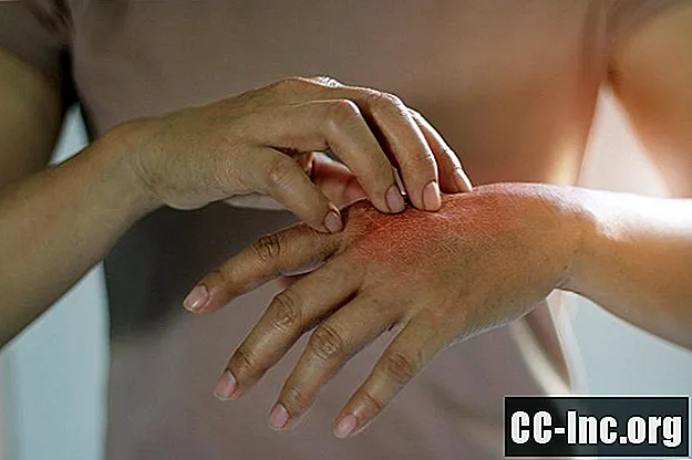 Hoe veel voorkomende huidinfecties eruit zien