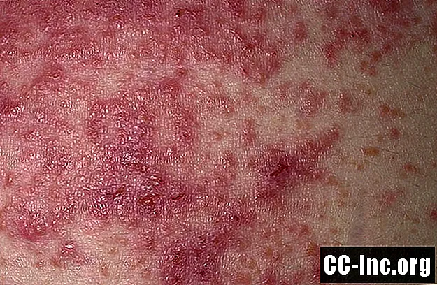 Qual é a aparência da dermatite herpetiforme