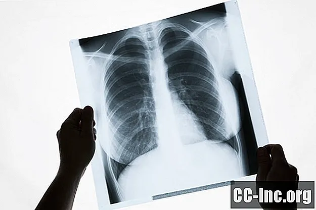 Apa itu Kanser Paru-paru ALK-Positif?