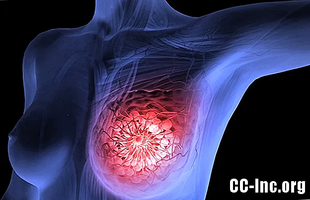 Какво представлява ракът на гърдата?