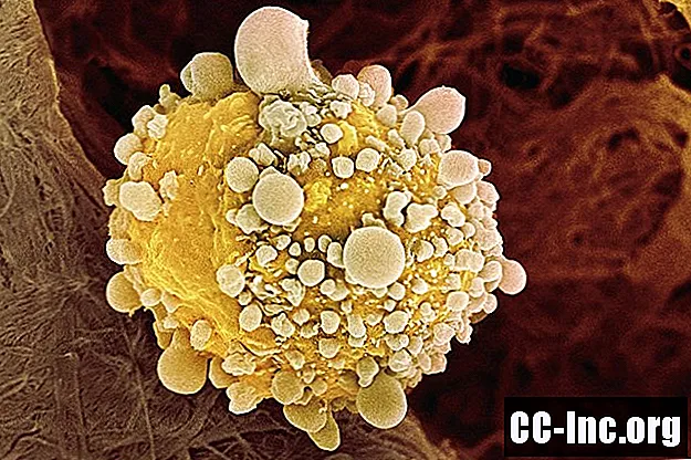 Kas ir aizkuņģa dziedzera vēzis?