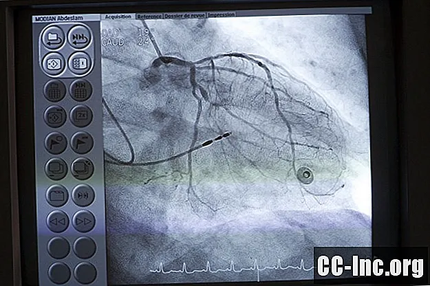 O que é cateterismo cardíaco? - Medicamento
