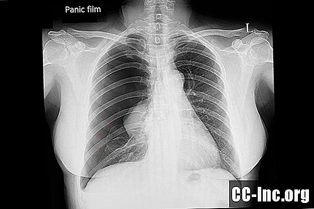 Hva er catamenial pneumothorax?