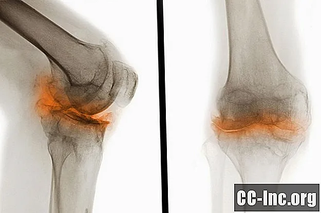 Evidencia de rayos X de osteoartritis