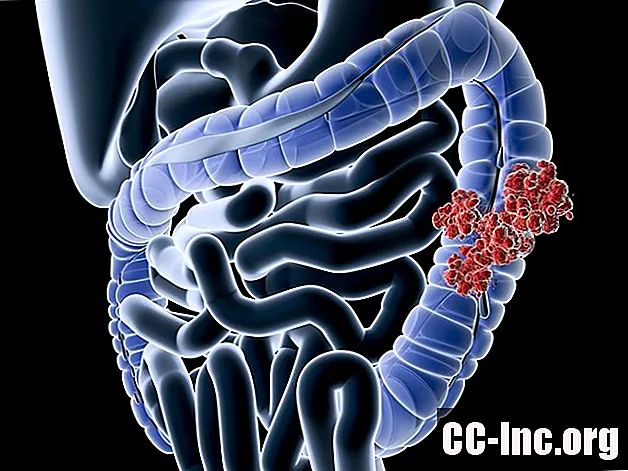 Ce este cancerul de colon?