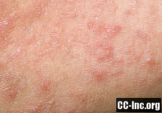 Mi a kontakt dermatitis?