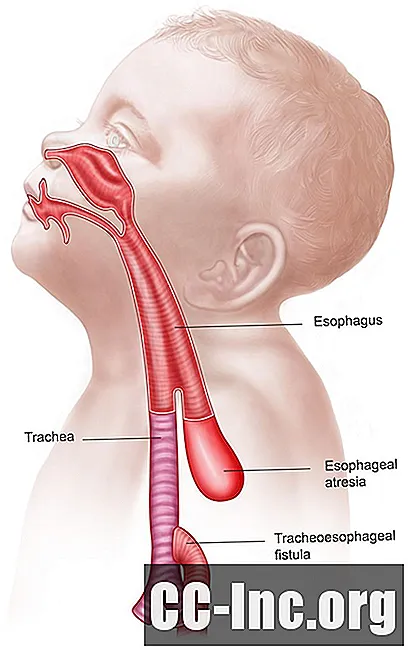O que é atresia esofágica?