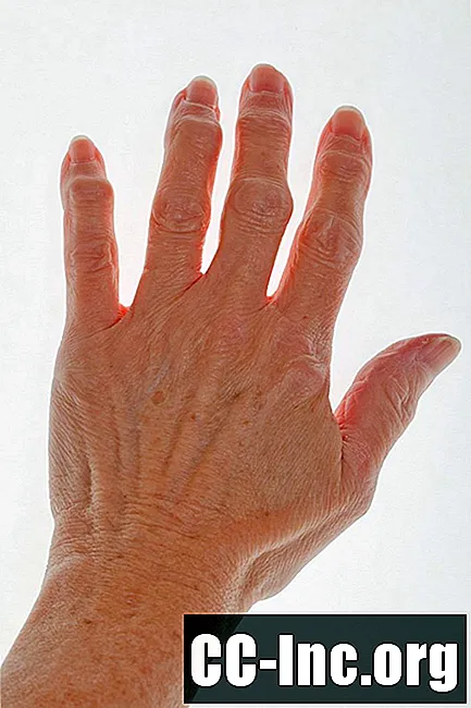 Что такое артрит пальцев?