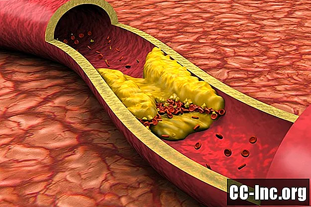 Što je visoki kolesterol?