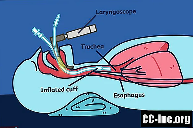 Vad är intubation och varför görs det?