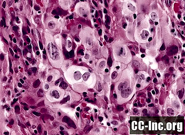 대 세포 폐암은 무엇입니까?