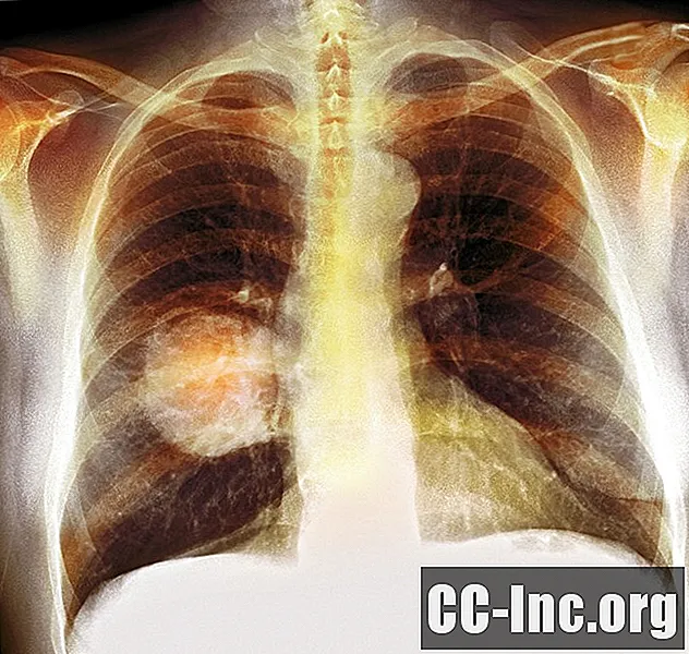 O que é câncer de pulmão? - Medicamento