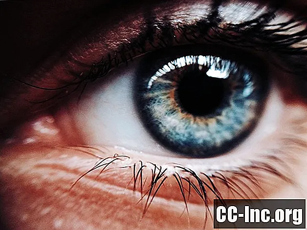 Операция по имплантации радужной оболочки глаза: все, что вам нужно знать