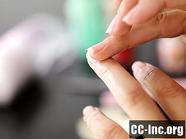 Какво е псориазис на ноктите?