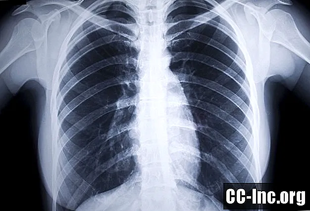 Hva er revmatoid lungesykdom?