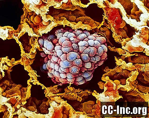 Kas ir 3. pakāpes nesīkšūnu plaušu vēzis?