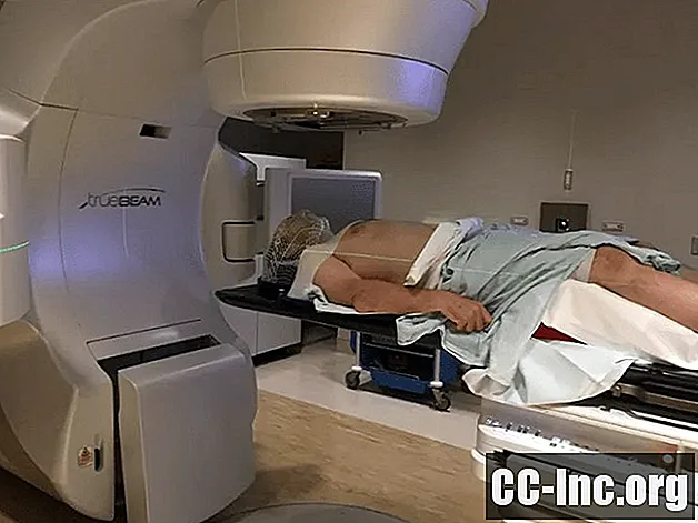 Che cos'è la radioterapia corporea stereotassica?
