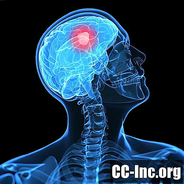 Kaj je možganski tumor?