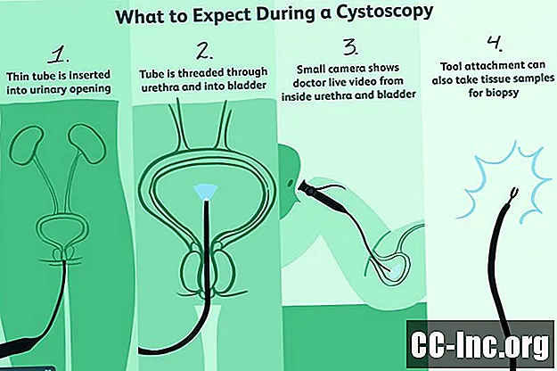 Kas yra cistoskopija?