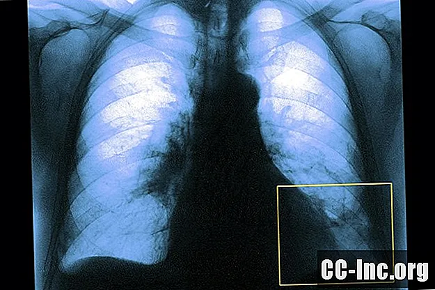 Che cos'è un'embolia polmonare?