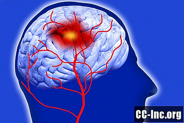 Hjerneslag forårsaket av amyloidangiopati