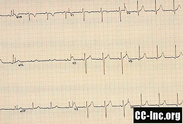 Ce este o electrocardiogramă (ECG)?