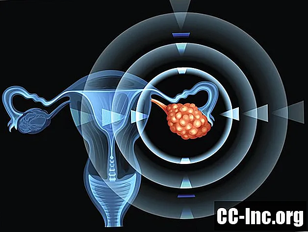 Vilka tester utvärderar en äggstocksmassa för cancer? - Medicin