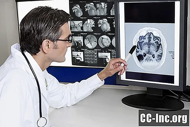 Razumijevanje lezija mozga povezanih s migrenom na vašem MRI