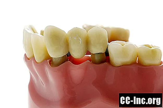 Ce que vous devez savoir sur l'obtention d'un bridge dentaire