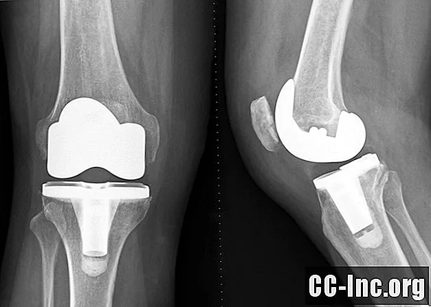 Was Sie über die Knieendoprothese wissen sollten