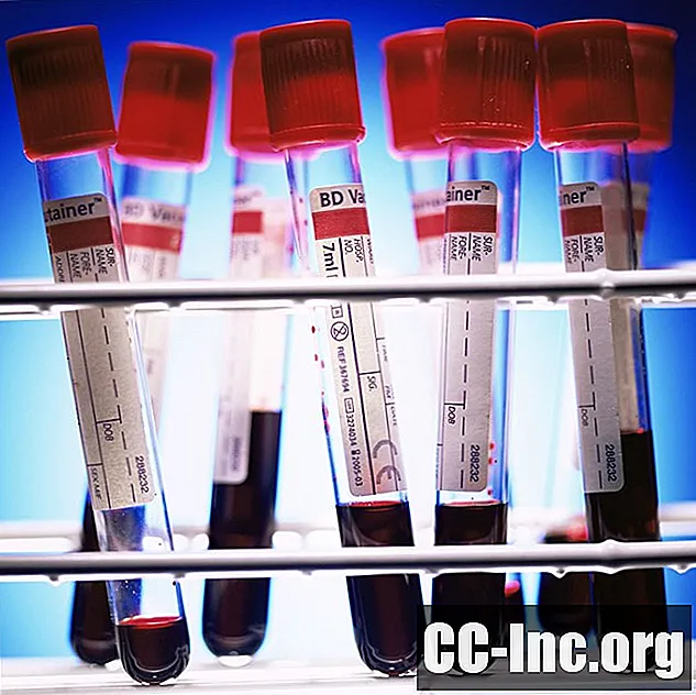 Какво представлява кръвният тест Vectra DA?