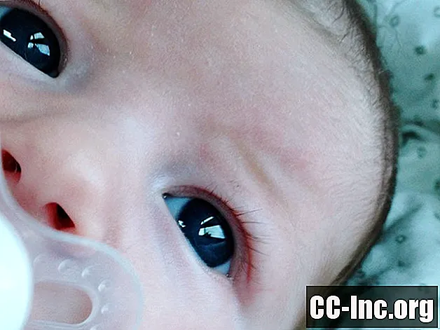 ماذا تفعل حيال إصابة حديثي الولادة بالعين