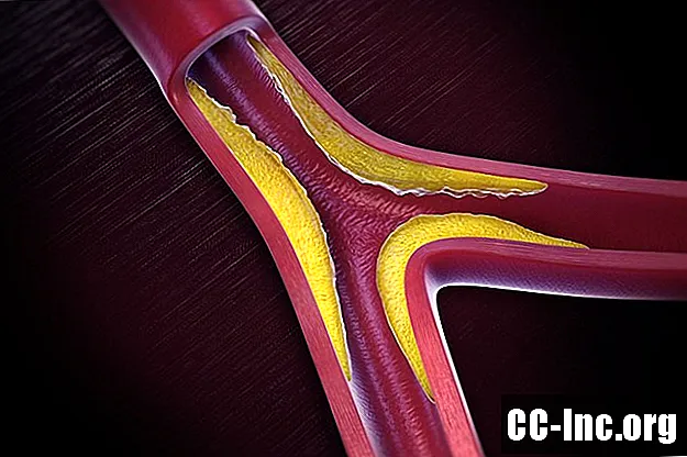 Yetişkinlerde İstenen Toplam Kan Kolesterol Seviyesi Nedir?