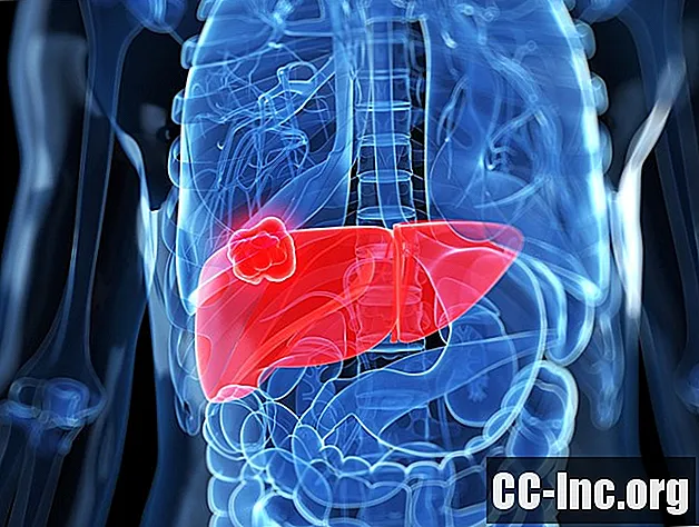 När lungcancer sprider sig till levern - Medicin