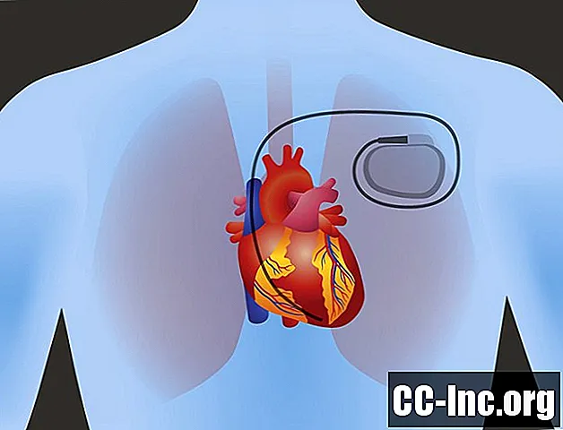 Når en pacemaker er nødvendig for en hjerteblokk