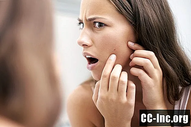 Cuándo consultar a un dermatólogo para tratar el acné