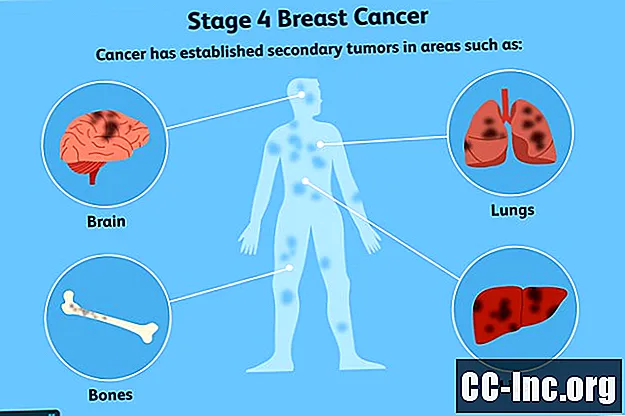 มะเร็งเต้านมสามารถแพร่กระจายได้ที่ไหน