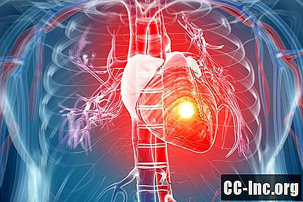 De ce unele atacuri de cord sunt tăcute?