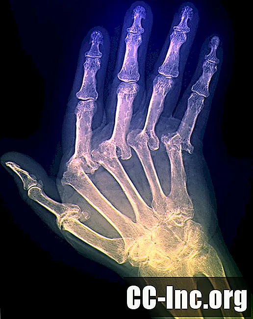 De ce ar trebui să vă cunoașteți tipul de artrită