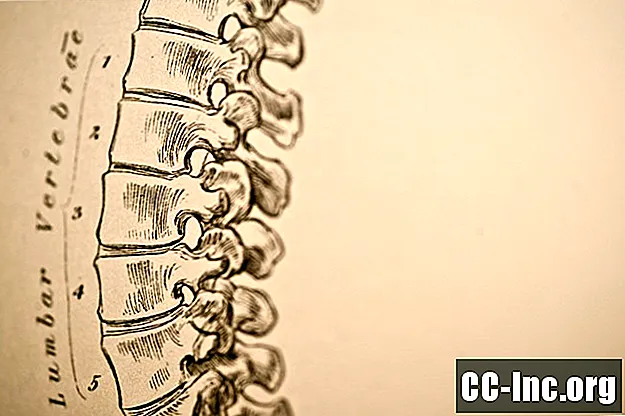 Miksi ristiselän selkäranka saattaa aiheuttaa selkäkipujasi